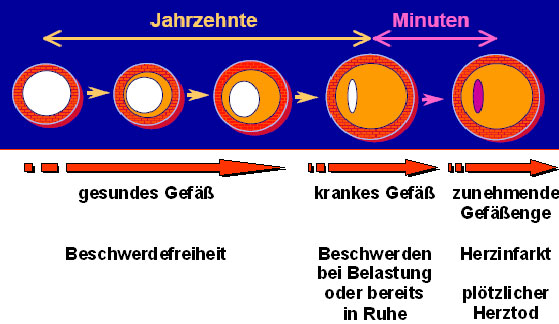 Herzinfarkt