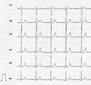 EKG