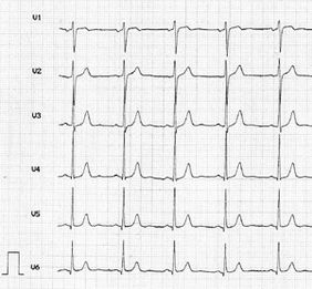EKG