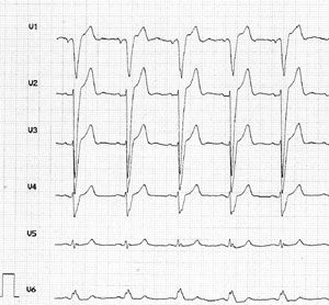 EKG