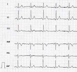 EKG