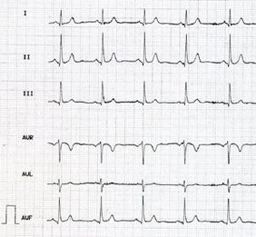 EKG