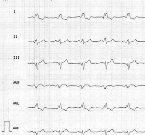 EKG