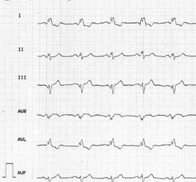 EKG